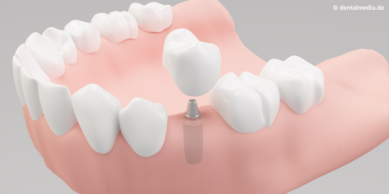 Implantologie : Ein Zahn fehlt Ein Implantat hat gegenüber einer Brücke den Vorteil, dass Nachbarzähne nicht beschliffen werden müssen.